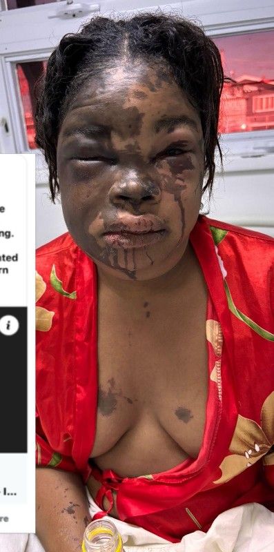 ACID ATTACK UPDATE | Victim now visually impaired