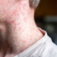 PAHO warns measles threat remains ‘very high’ as cases surge across Americas